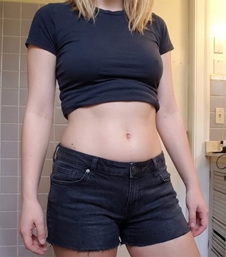 Patient after 6 weeks — flat abdomen